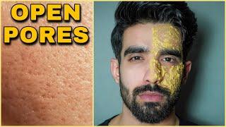 How to get rid of LARGE OPEN PORES NATURALLY | SHRINK LARGE PORES | Skin Care Hacks | Smooth Skin |