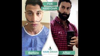 Beard Transplantation Turkey, Hair of Zrian, FUE, 4500 Graft