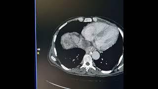 Hepatocellular carcinoma extending into inferior vena cava and right atrium.