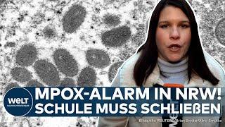 NRW: Mpox-Alarm! Neue Variante in Deutschland aufgetaucht! Schule in Rösrath bei Köln muss schließen