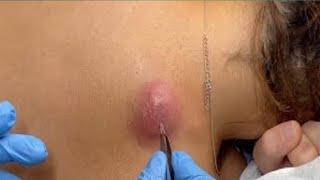 Big Cystic Acne Blackheads Extraction Blackheads & Whiteheads Removal pimple popping @SACDEPSPA