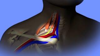 Thoracic Outlet Syndrome Care at UC Davis Medical Center