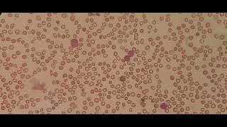 Blast cells in peripheral blood smear