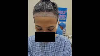 Female Hair transplant | Unique Hair grow Chennai | best hair transplant in chennai