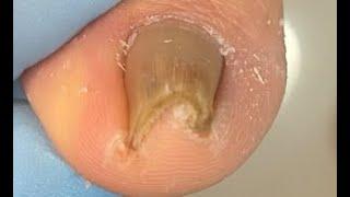 Extremely satisfying ingrown toenail treatment