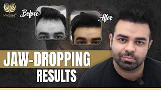 Jaw-Dropping Results | 8 Months Post Hair Transplant | MedLinks