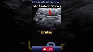 Ultrasound Tracing the mid Ureteric Stone          #ultrasound #stone #calculus