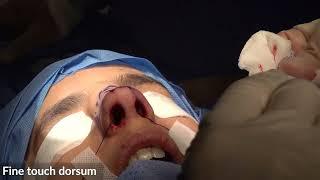 Hump Reduction/ Osteotomies/ Fascia-Lata-11/970:Rhinoplasty Bizrah- London/Dubai- Dr Bashar Bizrah