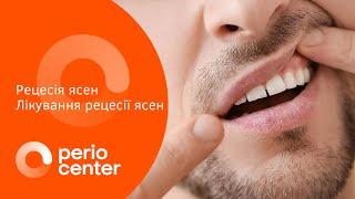 Рецесія ясен | клініка пародонтології Perio Center