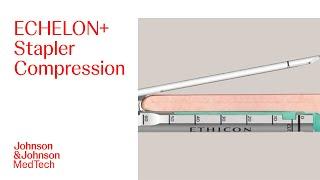 Examining Compression with ECHELON+ Powered Stapler with GST Reloads | J&J MedTech