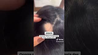 TIPOS DE QUEDA DE CABELO