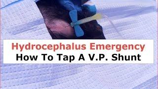 Hydrocephalus Emergency: How to Tap a VP Shunt