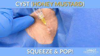 Cyst (Honey Mustard) Squeeze & Pop | Contour Dermatology