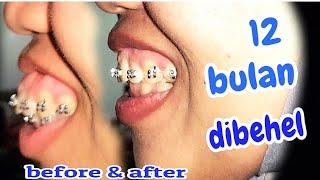perawatan behel gigi tonggos tulang maju, memperbaiki kegagalan behel, gummy smile dokter gigi Jogja