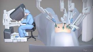 Robotic hysterectomy for high BMI patients | TVASurg