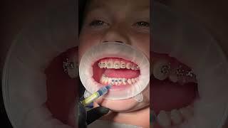 top and bottom braces in 30 seconds  #braces #dentist #illbearound