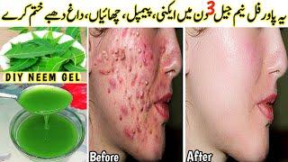 I appliedthis DIY Neem Gel on Acne, Pimples, Pigmentation,Bumps - Got Clear Glowing Skin In 3 Days