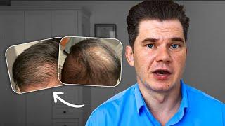 Can He Restore Hair By My Regrowth Routine?