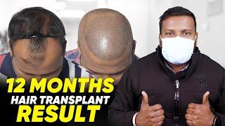 Hair Transplant in India | Best Results & Cost of Hair Transplant in India