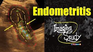 Endometritis || Ultrasound || Case 354