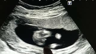 male gender on scan in 16th week