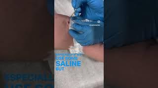 Treating an umbilical granuloma with silver nitrate