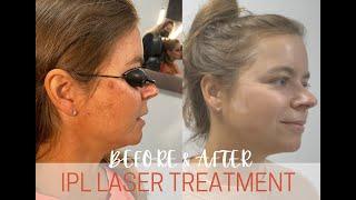 Intense Pulse Light (IPL) Treatment: Before and After Removing DARK SPOTS, WRINKLES, and More!