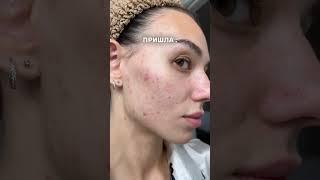 ПОЧЕМУ НЕЛЬЗЯ ВЫДАВЛИВАТЬ ПРЫЩИ? #акне #косметологказань #прыщи
