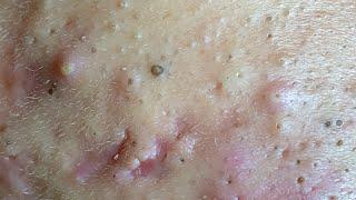 Make your Acne Treatment Huong Da Nang | 448# Hoang Part 1 | acne 2022