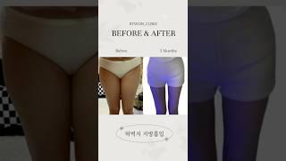 허벅지 지방흡입 리얼후기 #지방흡입후기