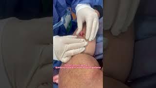 Extraction of lipoma or  lipedema nodule in woman with lipedema