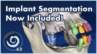 BSPV5.0: Implant Segmentation Now Included! Completely Automatic CT Segmentation! FREE