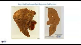 Liver: Hepatocellular carcinoma (Gross pathology)