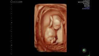 Baby Hallak #3 || 3D 4D Ultrasound at 12 Weeks Pregnant