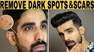 Remove DARK SPOTS & SCARS *NATURALLY* | ACNE SCARS, HYPERPIGMENTATION, BLACK SPOTS, ACNE MARKS |2021