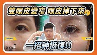 雙眼皮掉下來、越變越窄，告訴你割雙眼皮vs提眉哪個更有效！| 陳承謙醫師