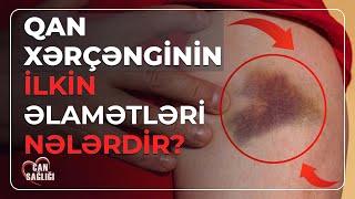 QAN XƏRÇƏNGİNİN YARANMA SƏBƏBİ NƏDİR? - CAN SAĞLIĞI (14.09.2023)