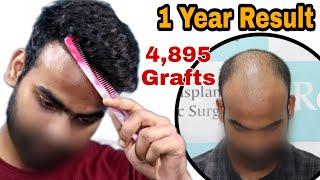 Best Hair Transplant Result 2021 || NW Grade V A || 1 Year Result ||  @Regrow Clinic ​