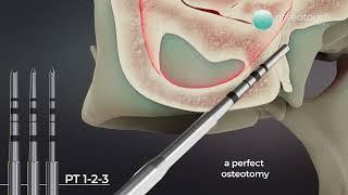 PT-1: a new solution for pterygoid implantology