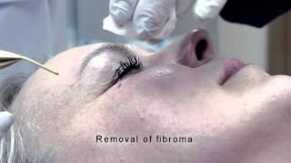 Jett Plasma Lift Medical - Removal of skin imperfections