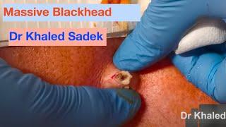 Massive Blackhead Removed. Dr Khaled Sadek. Www.lipomacyst.com