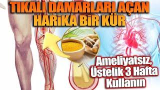 Tıkalı Damarları Açan Harika Bir Kür. Ameliyatsız, Üstelik 3 Hafta Kullanın