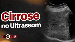 CIRROSE  - APRENDA A RECONHECER NO ULTRASSOM I VOCÊ RADIOLOGISTA