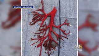 Man Coughs Up 6-Inch Blood Clot in Shape of a Bronchial Tree, Dies