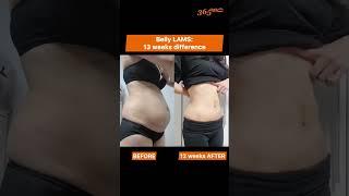 365mc SHORTS | Minimal Invasive Liposuction LAMS on Belly | Before and After 13 weeks