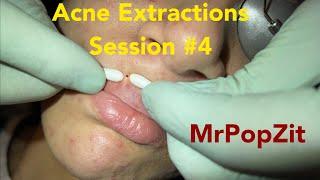 Acne Extractions 2.0 session #4. Blackheads, whiteheads. Wait for the last pop, it’s got distance!