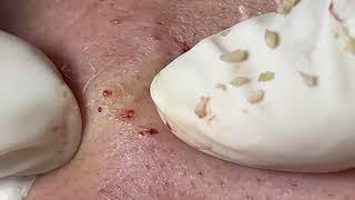 Acne Treatment Huong Da Nang# _ 2024   #blackheads 707