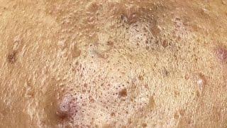 Acne Treament Under The Skin #051