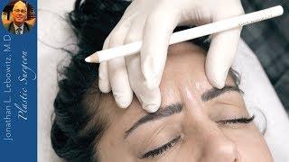 Botox: Forehead/Eyes in a Young Woman For A More Youthful Appearance At Lebowitz Plastic Surgery, NY