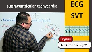 supraventricular tachycardia SVT ( English ) ECG